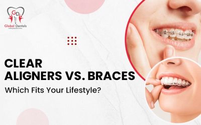 Clear Aligners vs. Braces – Which Fits Your Lifestyle?