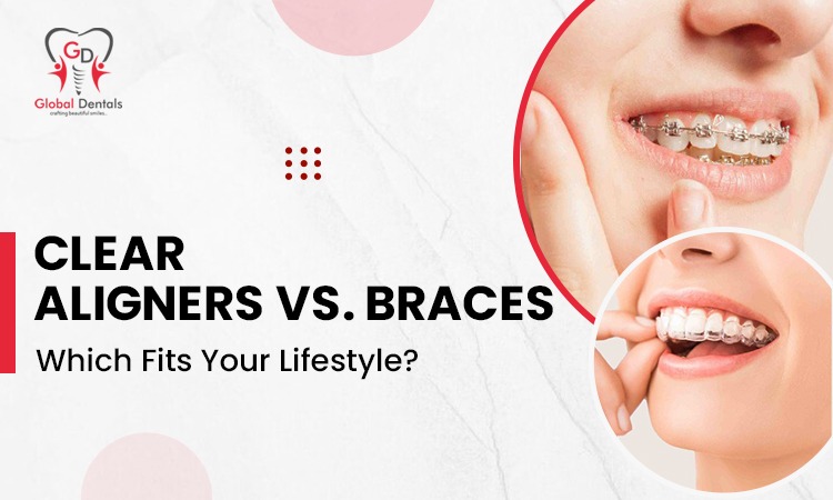 Clear Aligners vs. Braces - Which Fits Your Lifestyle?