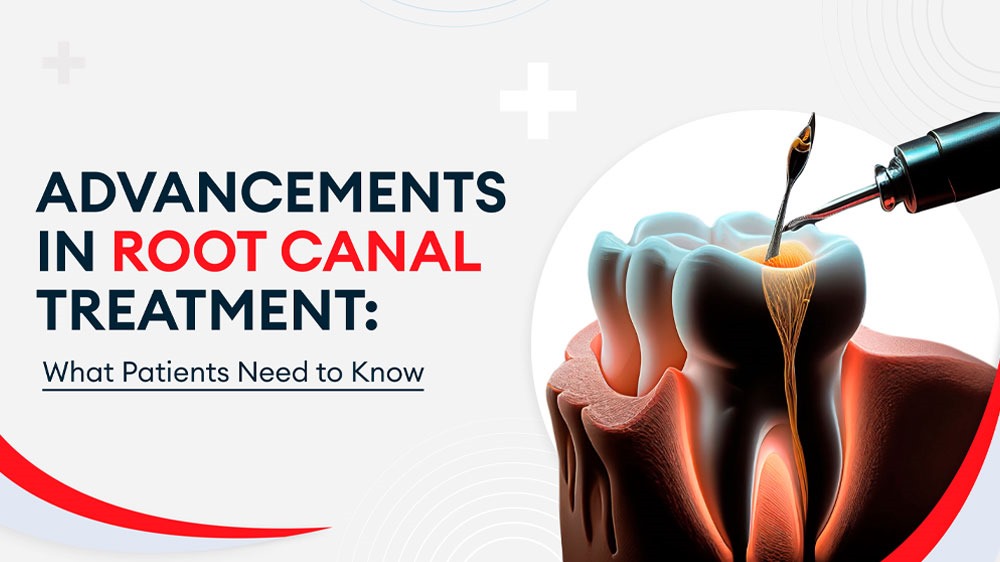 Advancements in Root Canal Treatment: What Patients Need to Know