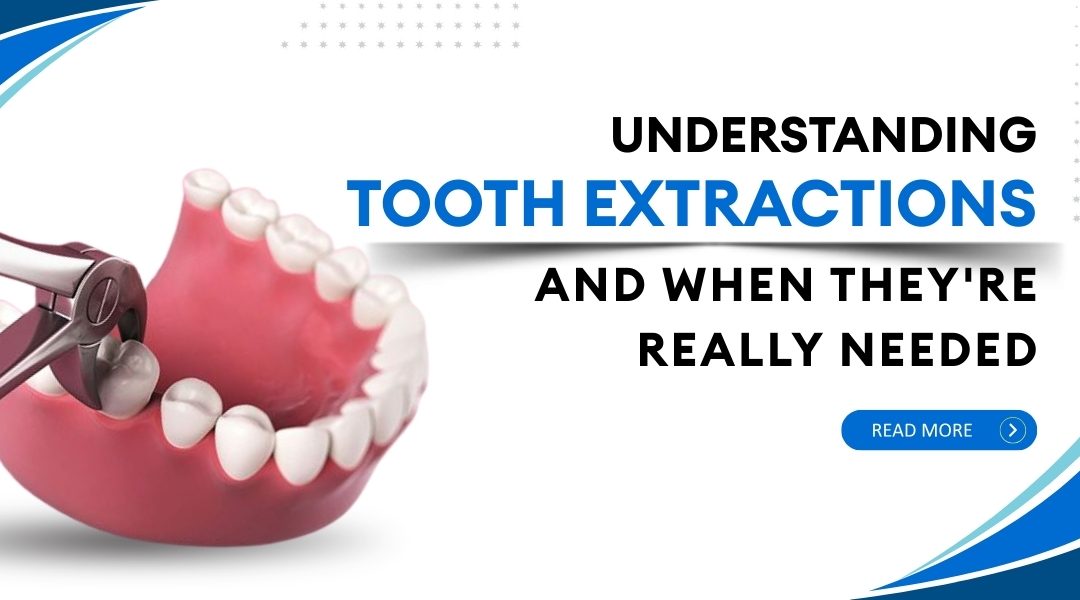 Understanding tooth extraction and when they’re really needed