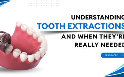 Understanding tooth extraction and when they’re really needed