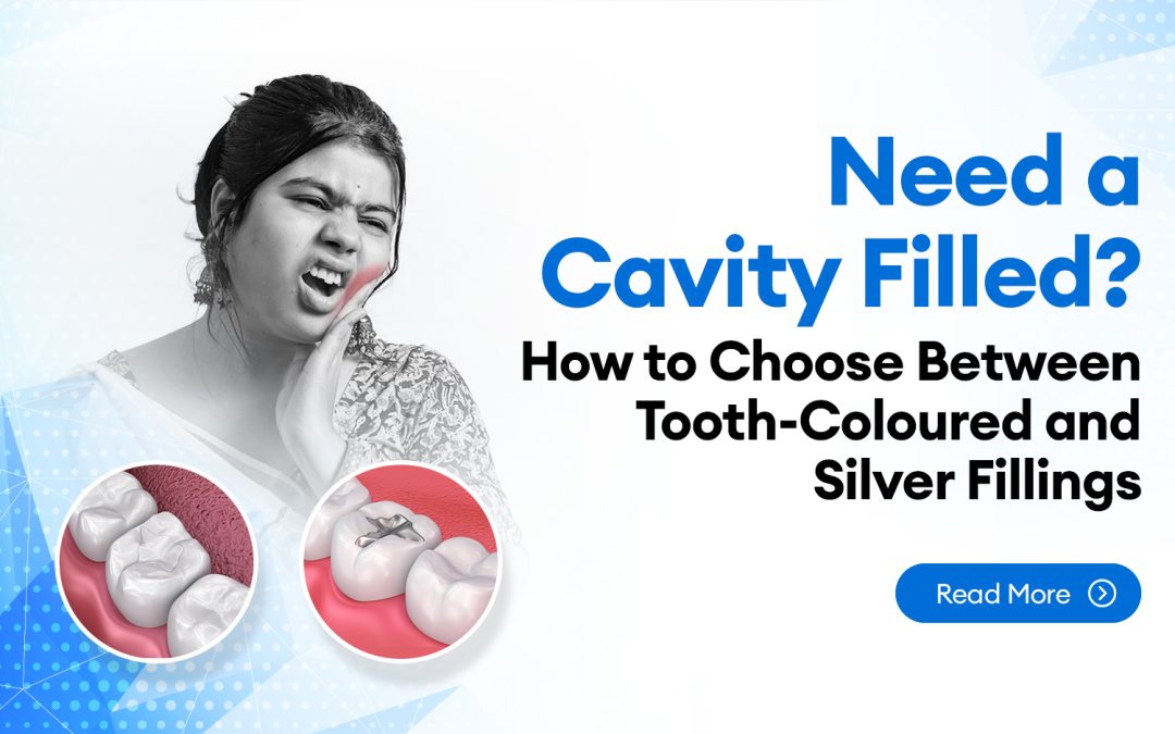 Need a Cavity Filled? How to Choose Between Tooth-Coloured and Silver Fillings