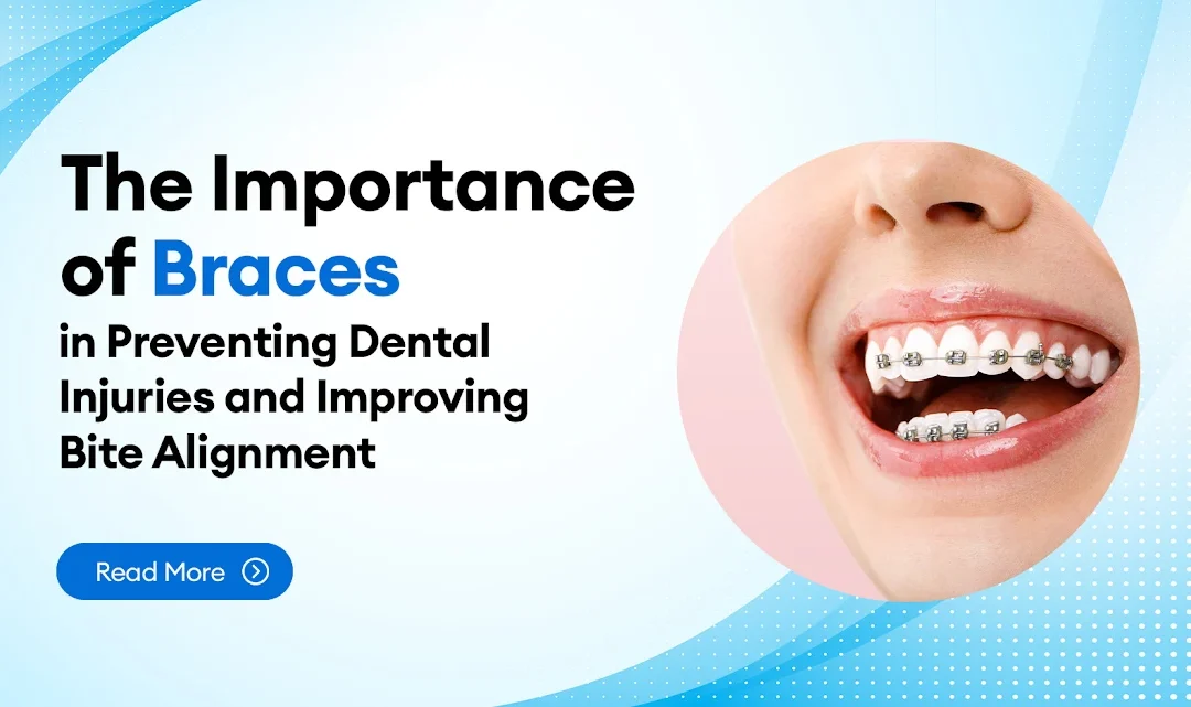 The Importance of Braces in Preventing Dental Injuries and Improving Bite Alignment