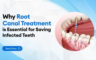 Why Root Canal Treatment is Essential for Saving Infected Teeth