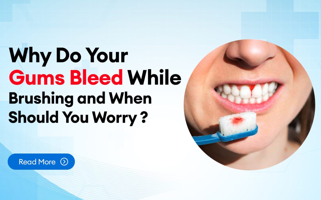Why Do Your Gums Bleed While Brushing and When Should You Worry?