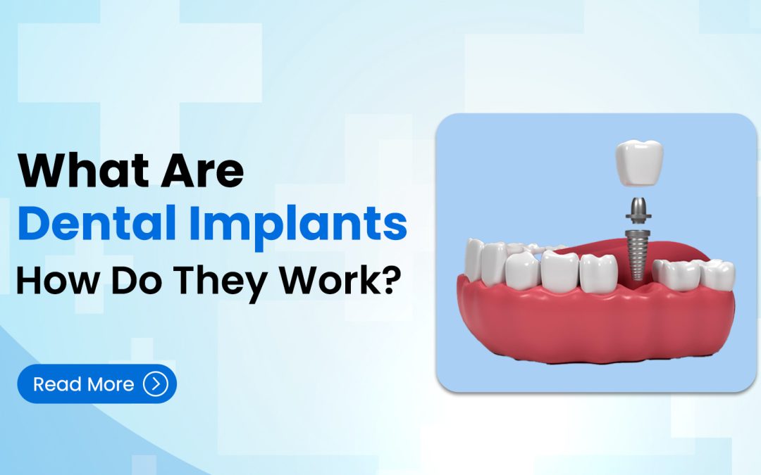 What Are Dental Implants and How Do They Work?