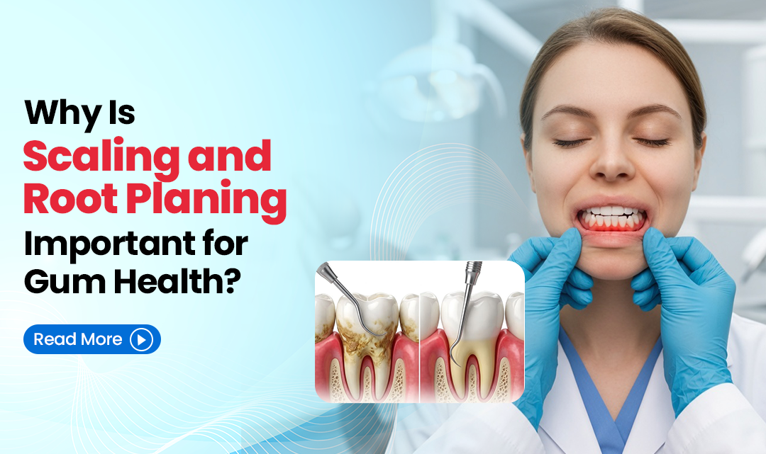 Why Is Scaling and Root Planing Important for Gum Health?