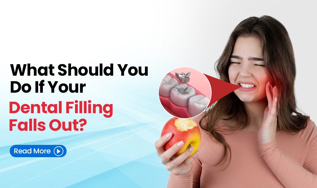 What Should You Do If Your Dental Filling Falls Out?