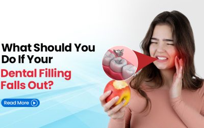 What Should You Do If Your Dental Filling Falls Out?