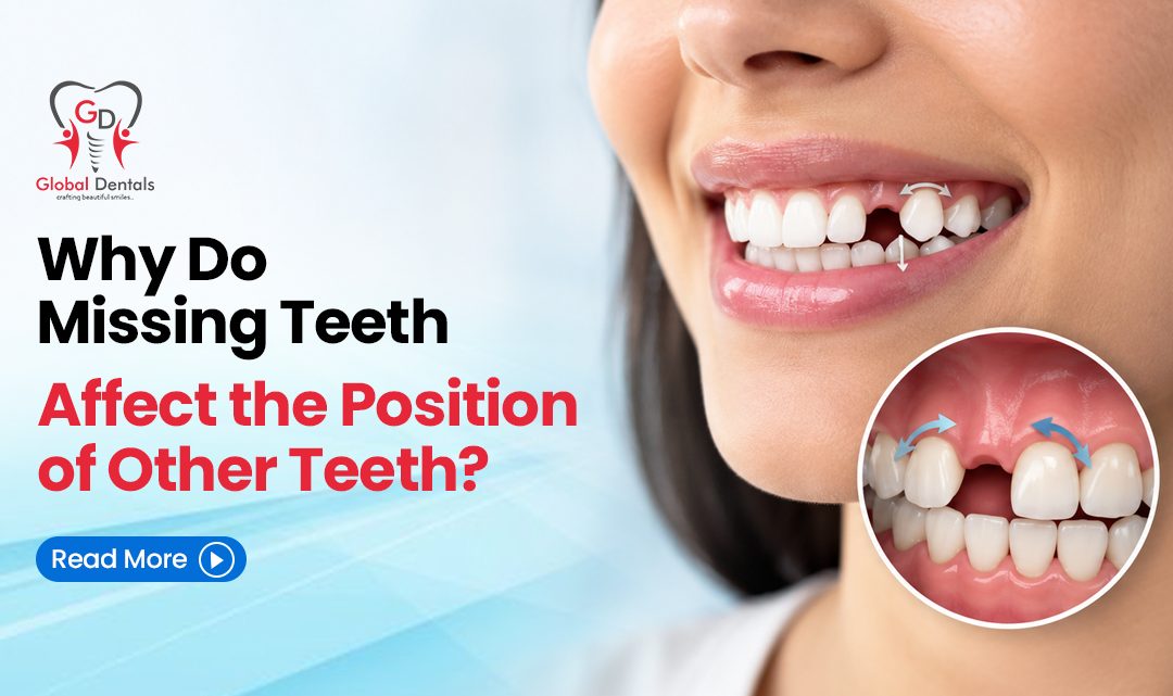 Why Do Missing Teeth Affect the Position of Other Teeth?