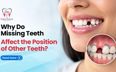 Why Do Missing Teeth Affect the Position of Other Teeth?